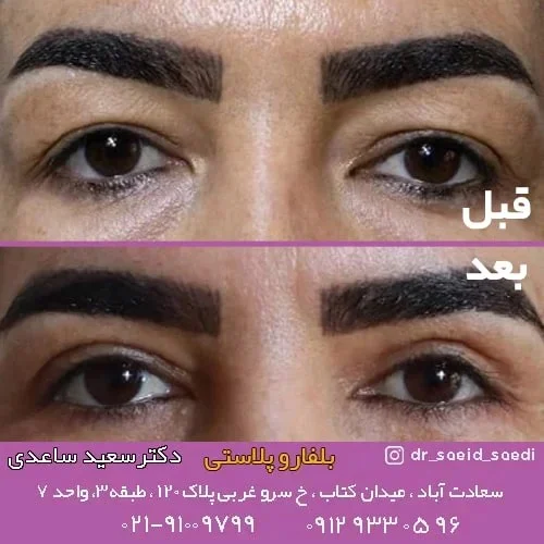 عمل بلفاروپلاستی پلک