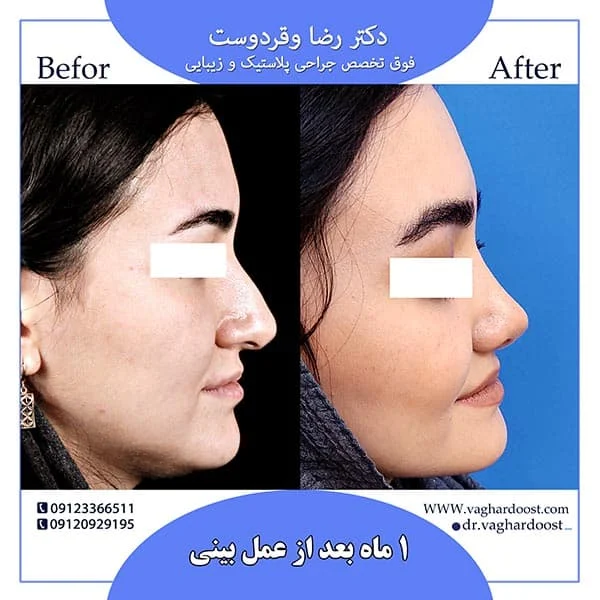 جدیدترین روش های جراحی بینی
