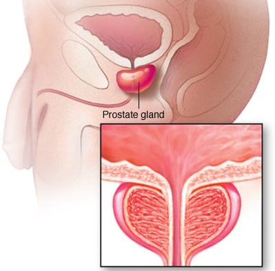 درمان بزرگی پروستات در ایران