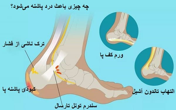 علت درد پاشنه پا + دلایل و درمان خانگی آن