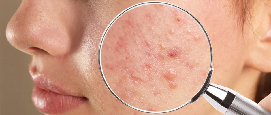 کرم ترمیم کننده صورت برای پوست های آسیب دیده از دکلره
