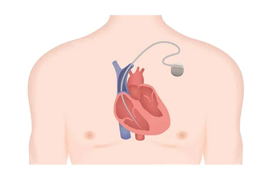 پیس میکر قلب چیست؟