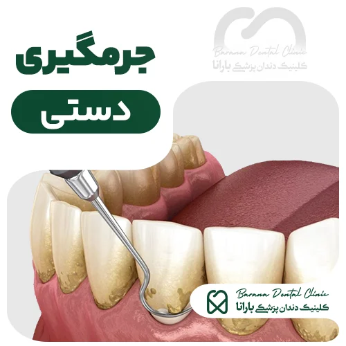 جرمگیری دستی دندان