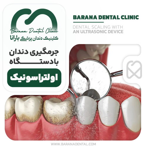 جرمگیری دندان با دستگاه اولتراسونیک
