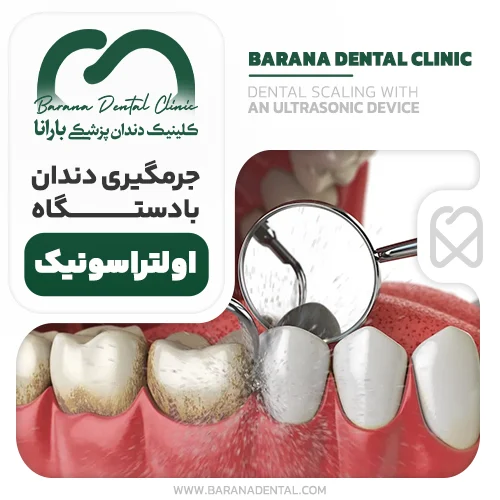 جرمگیری دندان با دستگاه اولتراسونیک