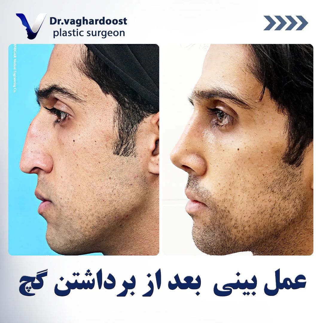 جدیدترین روش های جراحی بینی