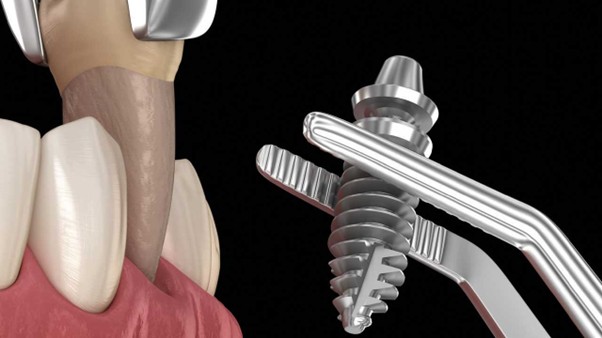 ایمپلنت چند ماه بعد از کشیدن دندان می توان ایمپلنت کرد؟
