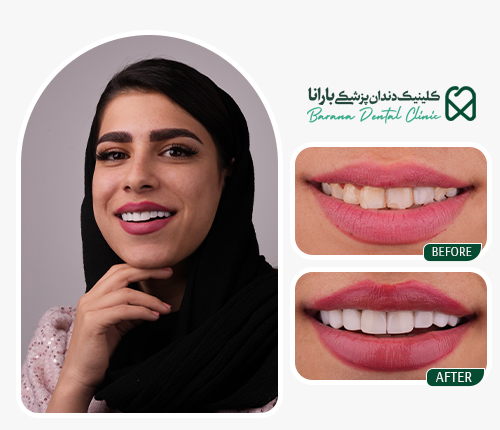 مراقبت های بعد از کامپوزیت دندان