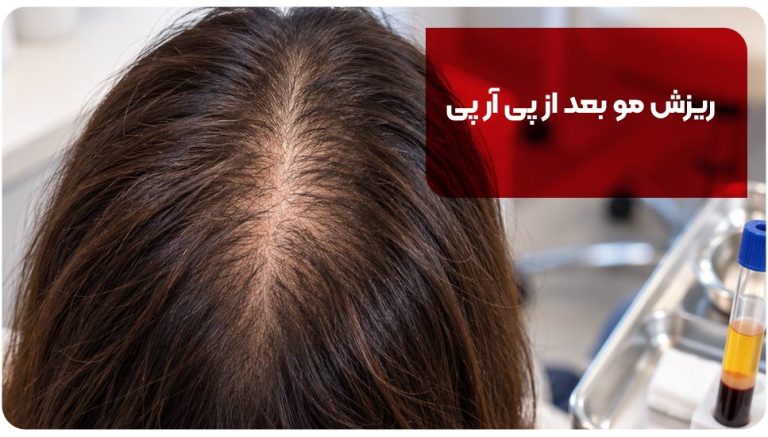ریزش مو بعد از پی آر پی