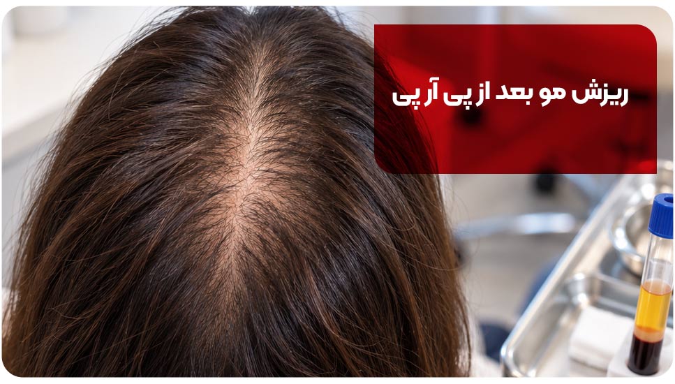 ریزش مو بعد از پی آر پی
