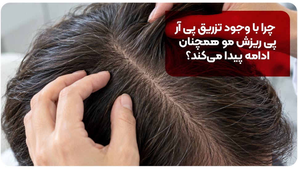 ریزش مو | پوست ریزش مو بعد از پی آر پی