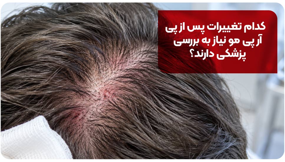 ریزش مو | پوست ریزش مو بعد از پی آر پی
